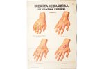 poster, Yperite effect on human body, Latvia, 1933, 69.9 x 49.8 cm, publisher - Armijas inzhenieris...