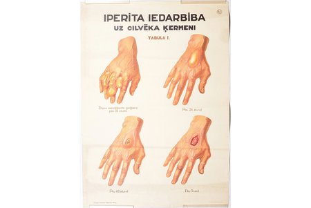 plakāts, Iprīta iedarbība uz cilvēka ķermeni, Latvija, 1933 g., 69.9 x 49.8 cm, izdevējs - Armijas inženieris